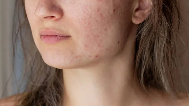 Dermatology in Fargo ND Skincare Facials Fargo