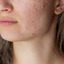 Dermatology in Fargo ND - Skincare Facials Fargo