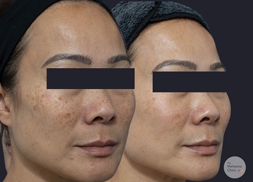 c2 The Melasma Clinic
