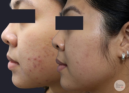 c3 The Melasma Clinic
