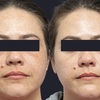 x1 - The Melasma Clinic