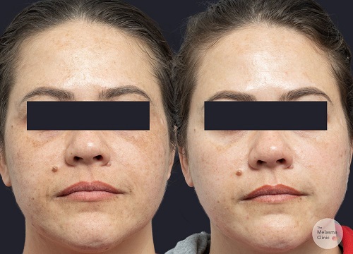 x1 The Melasma Clinic