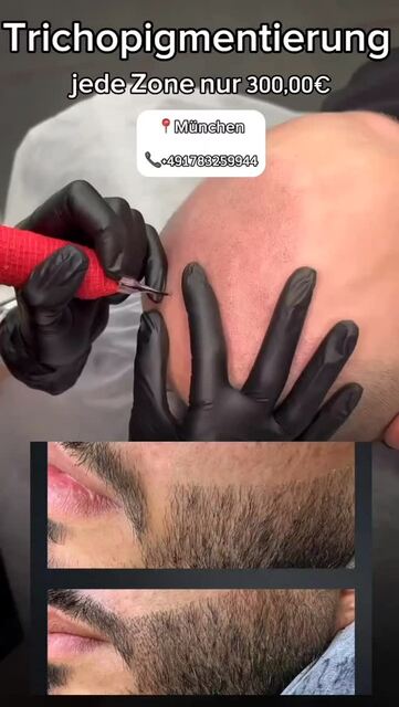 Haartransplantation Narben kaschieren Picture Box