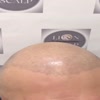 Haartransplantation Narben ... - Picture Box