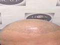 Haartransplantation Narben ... - Picture Box