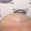 Haartransplantation Narben ... - Picture Box