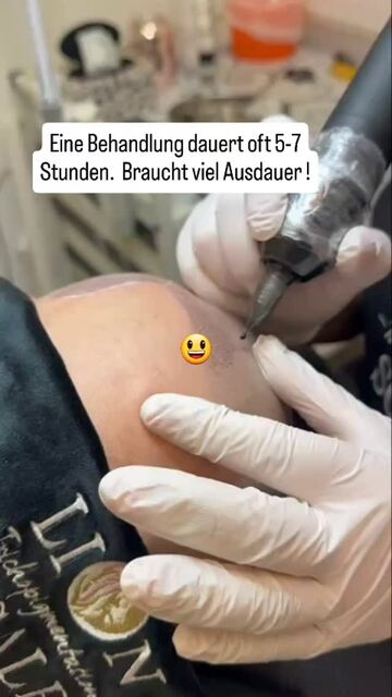 SMP Pigmentation München | lionscalp Picture Box
