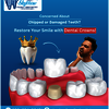 chipped tooth repair seattle - Picture Box