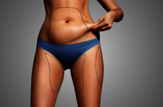 Fat-reduction-and-muscle-building-adelaide-2-1024x Best Cellulite Reduction Treatments That Really Work