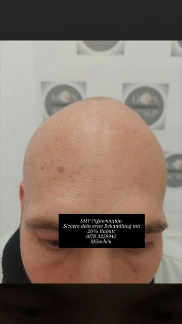 SMP Pigmentation München | lionscalp Picture Box
