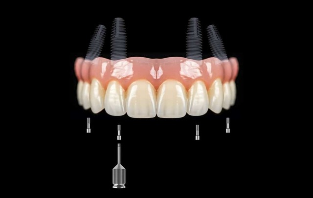 Permanent Dental Implants in Mount Prospect, IL simplyteethmountprospect
