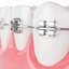 Kids Orthodontist - Kids Orthodontist & Children's Braces of Queens