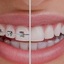 Orthodontist Near Me - Kids Orthodontist & Children's Braces of Queens