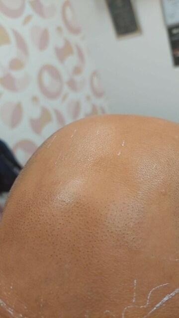 SMP Pigmentation München | lionscalp Picture Box