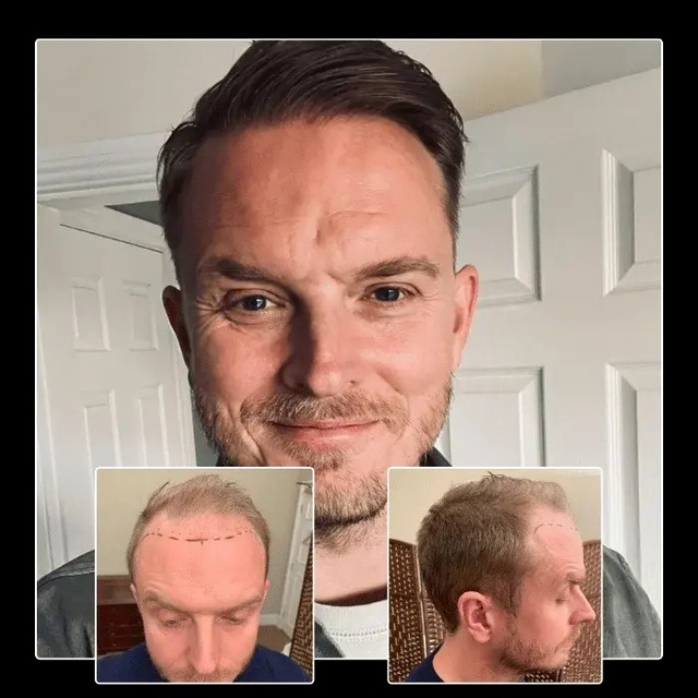 0d234b36-cda0-481c-acce-ff65b49ec544 Capital Hair Restoration - Hair Transplant