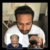 3f9ed206-47b3-4ec1-b832-c74... - Capital Hair Restoration - ...