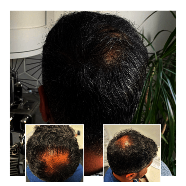 06608eb8-d6f3-4e62-abd8-dc91a6c7c4c5 Capital Hair Restoration - Hair Transplant