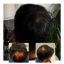 06608eb8-d6f3-4e62-abd8-dc9... - Capital Hair Restoration - Hair Transplant