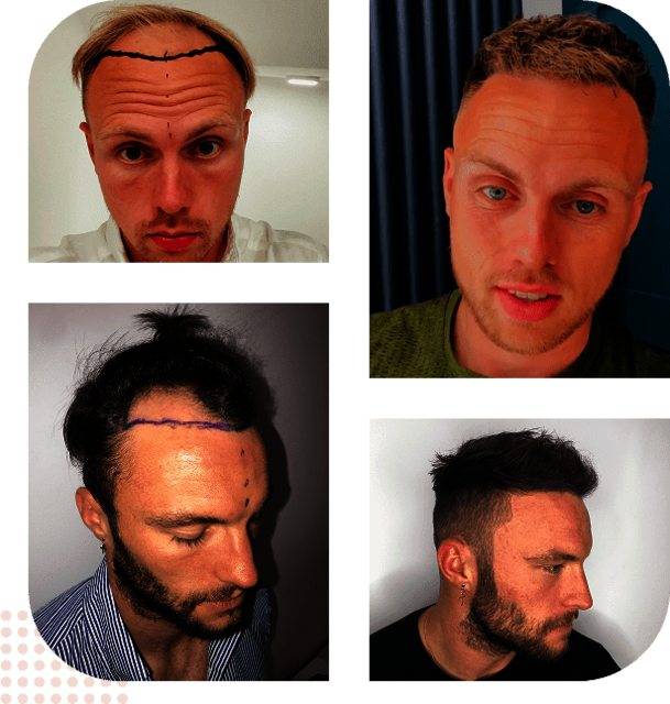 37619586-5997-4a25-a5f7-c06ed17df8f5 Capital Hair Restoration - Hair Transplant