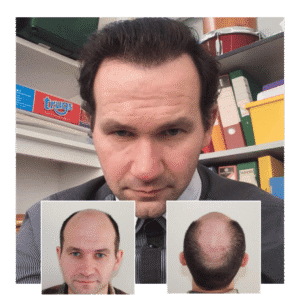 bae9ced8-9fad-43f1-81cc-68b589e9b20c Capital Hair Restoration - Hair Transplant