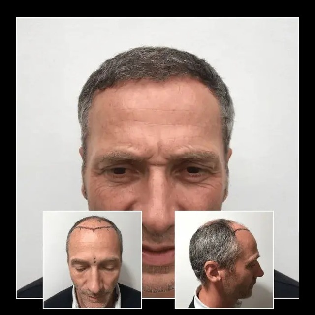 f5722d58-56e5-49ab-8863-855ed788988c Capital Hair Restoration - Hair Transplant