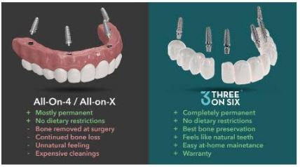 3 on 6 dental implants Las Vegas 3 on 6 Dental Implants Las Vegas | All Out Dental