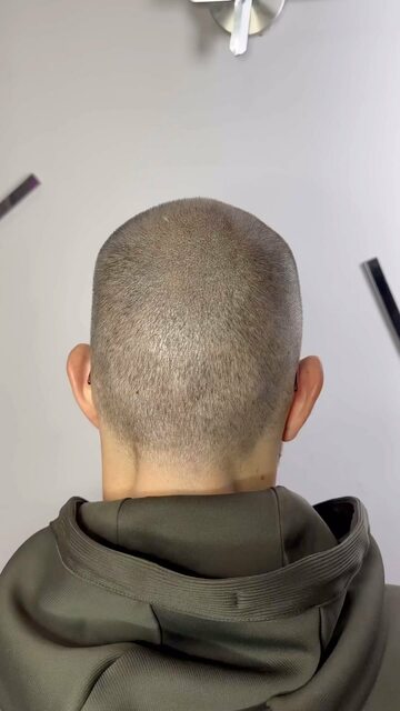 Trichopigmentation München | lionscalp Picture Box