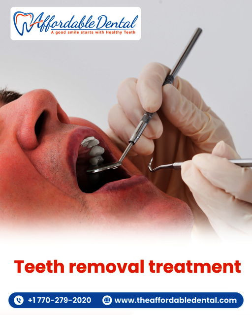 Teeth Removal Treatment Picture Box
