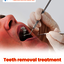 Teeth Removal Treatment - Picture Box