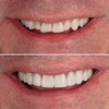 Invisalign beaconsfield (2) - Define Dental Clinic