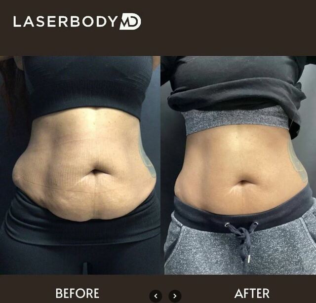 Laser hair removal (2) Laserbody MD