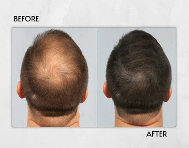 hair restoration Laserbody MD