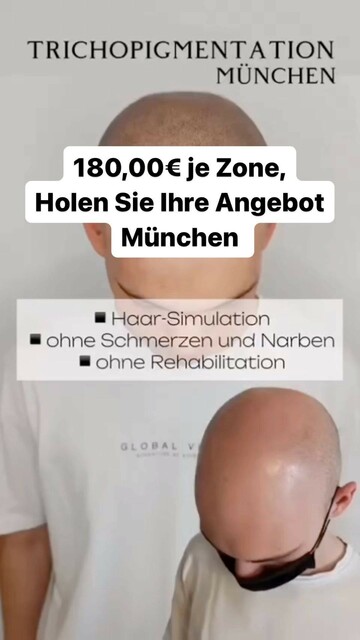 SMP Pigmentation München | lionscalp Picture Box