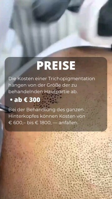 Haarpigmentierung münchen | lionscalp Picture Box