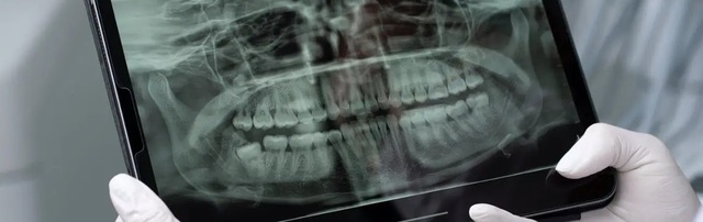 root canal NJ Affordable Same Day Root Canal