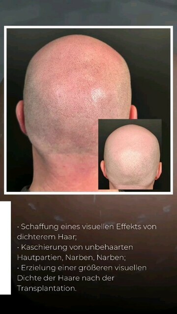 SMP Pigmentation München | lionscalp Picture Box