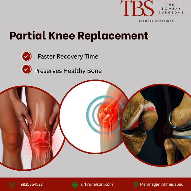Partial Knee Replacement Surgery Orthopedic Surgeon