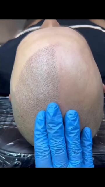 Haarpigmentierung und Haarausfall München Picture Box