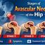 Stages of avascular necrosi... - Hip Xpert