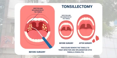 Tonsil Surgery & Adenoidectomy Treatment Best ENT Hospital in Hyderabad | MicroCare ENT Hospitals