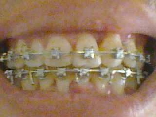 Teeth wif braces 2 months 2wks 2days - 
