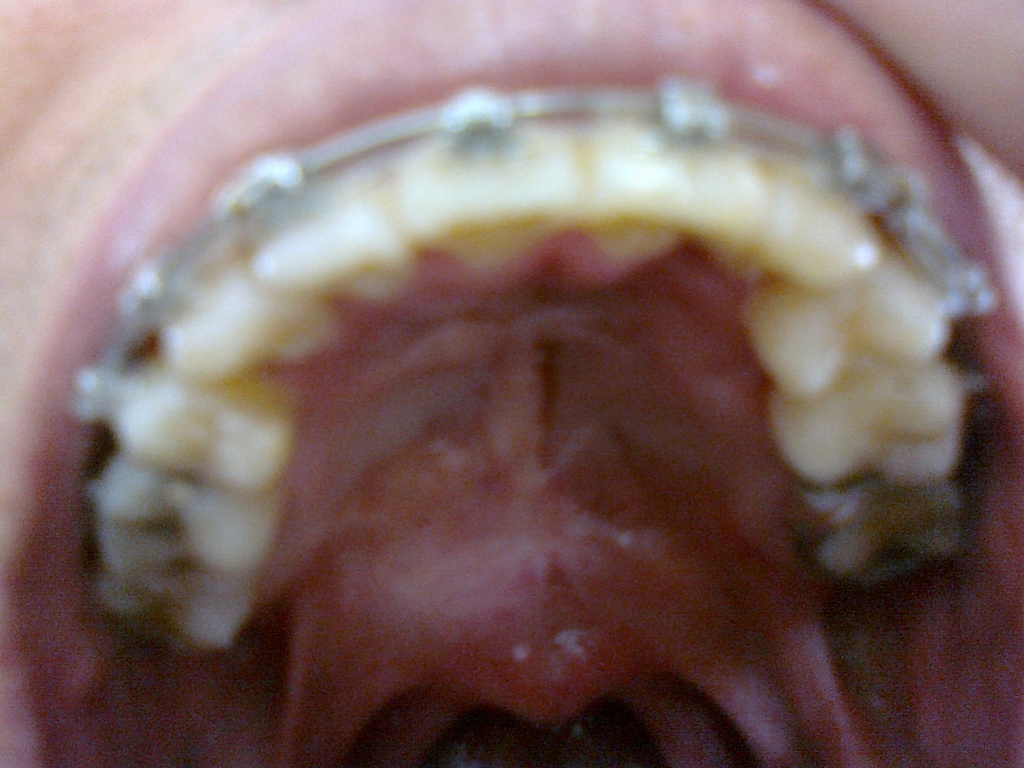 Upper jaw 2 months 2wks 2days - 