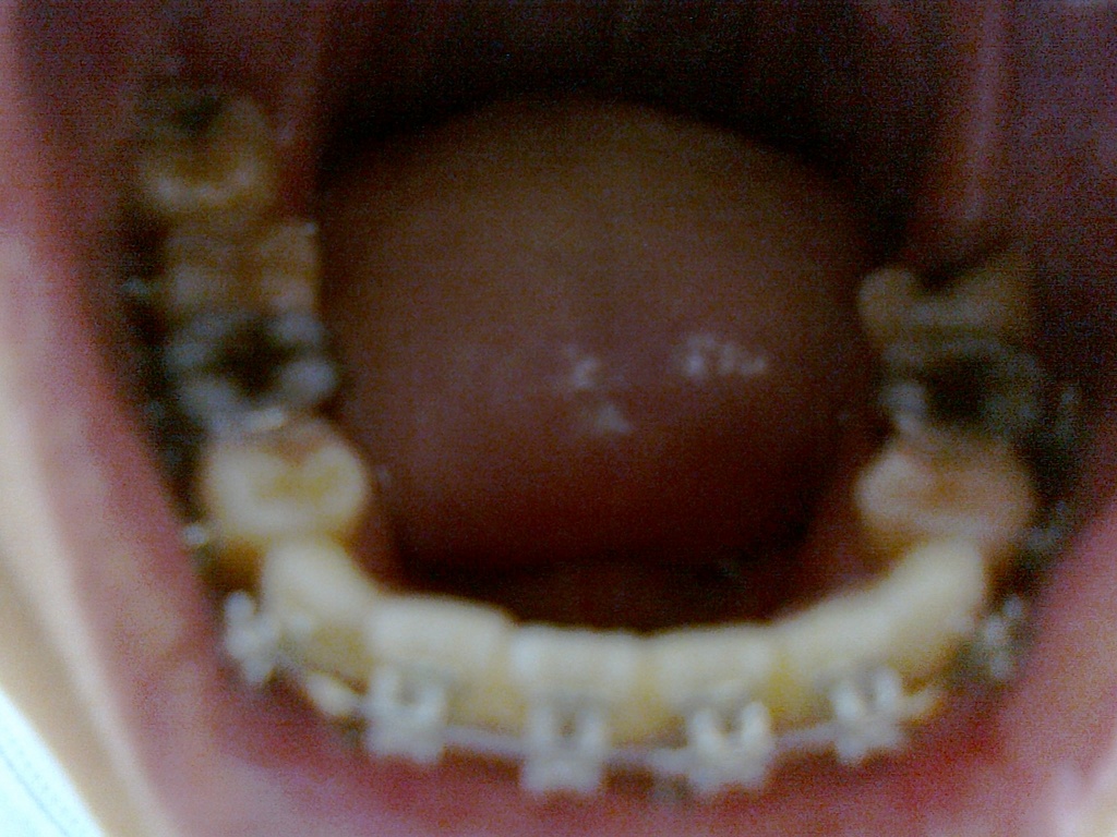 Lower jaw 2 months 2wks 2days - 