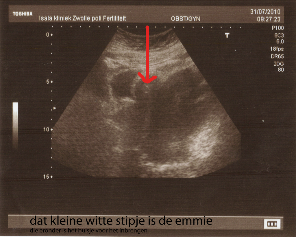 bewerkte eerste echo - 