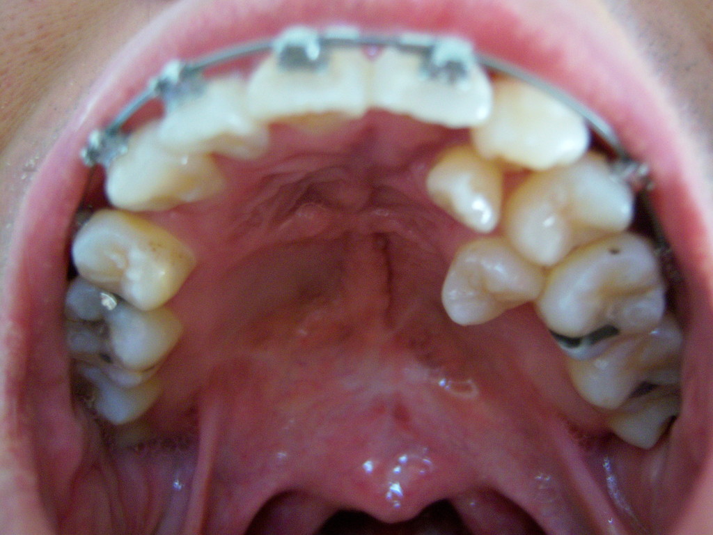 Upper row 5th adjustment - 