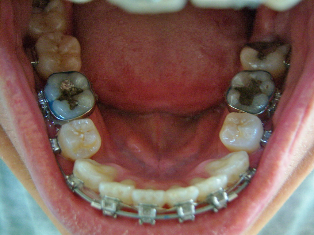 Lower row 5th adjustment - 