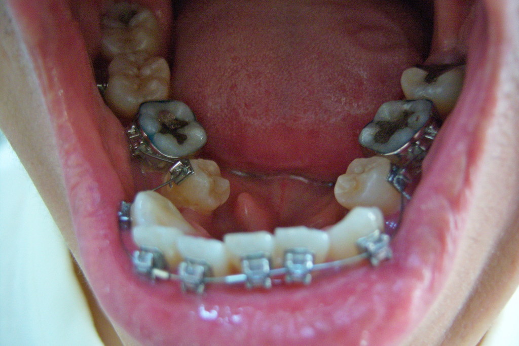 Lower  row after extraction - 